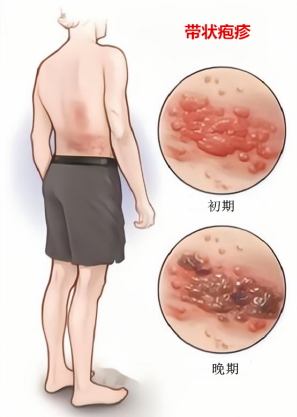 苗医带状疱疹